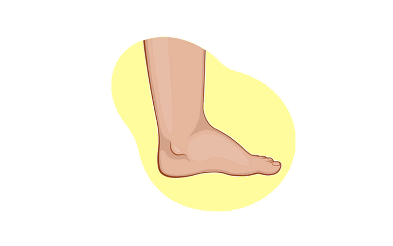 How to Treat Swollen Ankles Understanding and Solutions to This Problem