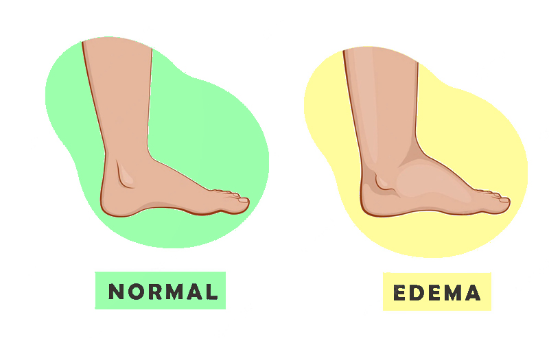 Swollen leg and Normal leg illustrations 